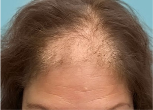 лечение потери волос